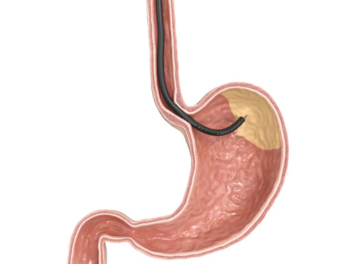 GMA with MOVIVA®: Setting New Standards in Endoscopic Bariatric Treatment.