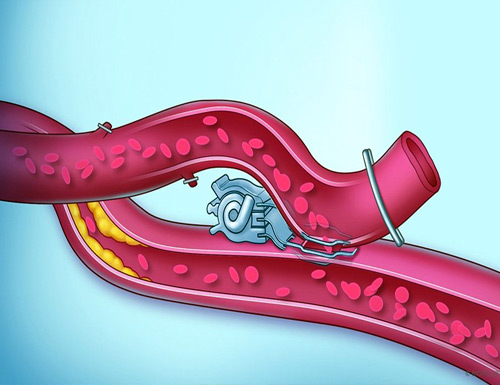 To Revolutionize Coronary Artery Bypass Surgery, AMT Medical Secures $25 Million in Series B Funding