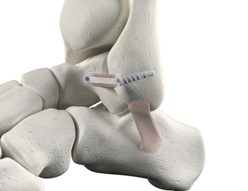 Medline to launch a synthetic ligament augmentation implant.