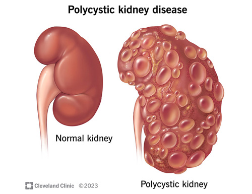 To Target the Multi-Billion Dollar Kidney Disease Market, Mezzion Expands Its Udenafil Pipeline to ADPKD