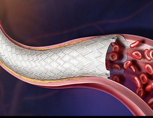 BD Strengthens Peripheral Vascular Innovation Leadership with Positive AGILITY Trial Results