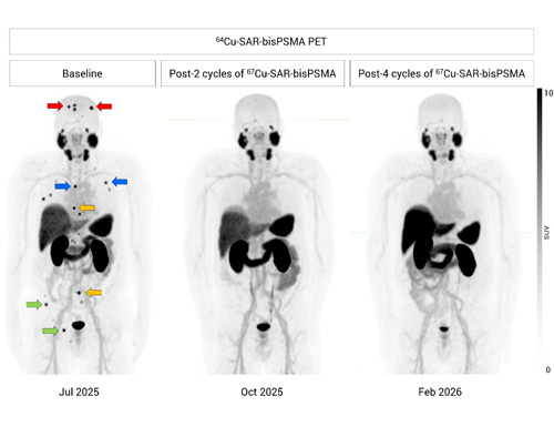 SECuRE trial update: Another participant with negative PSMA PET and undetectable PSA