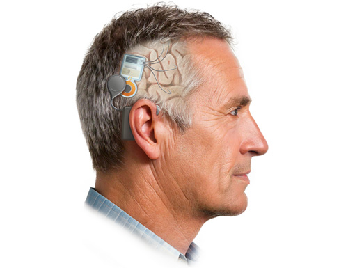 Peer-reviewed validation of a 60-channel closed-loop neurostimulation brain implant is published by Nia Therapeutics